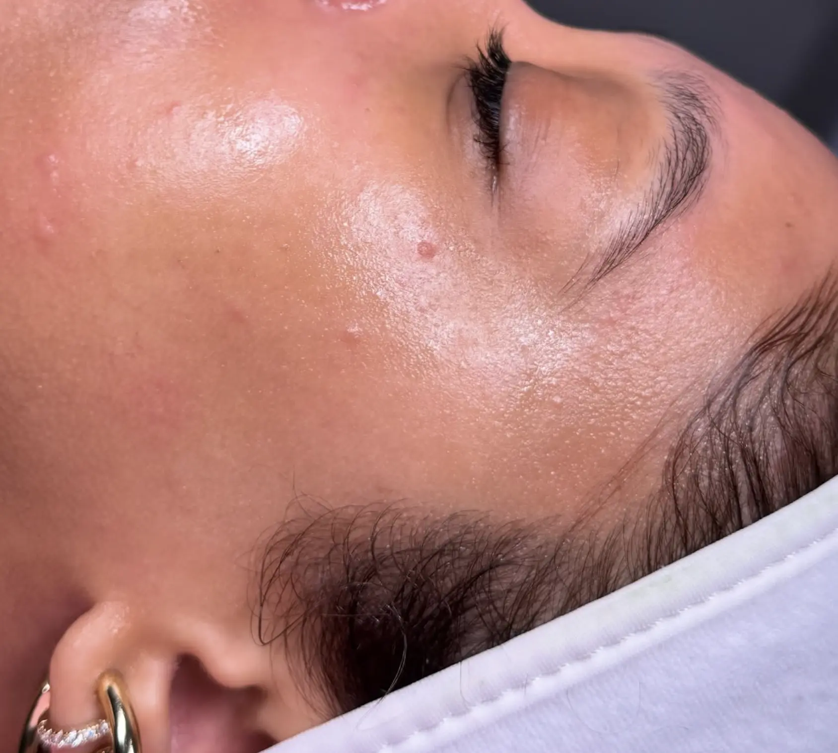 skin needling Brisbane